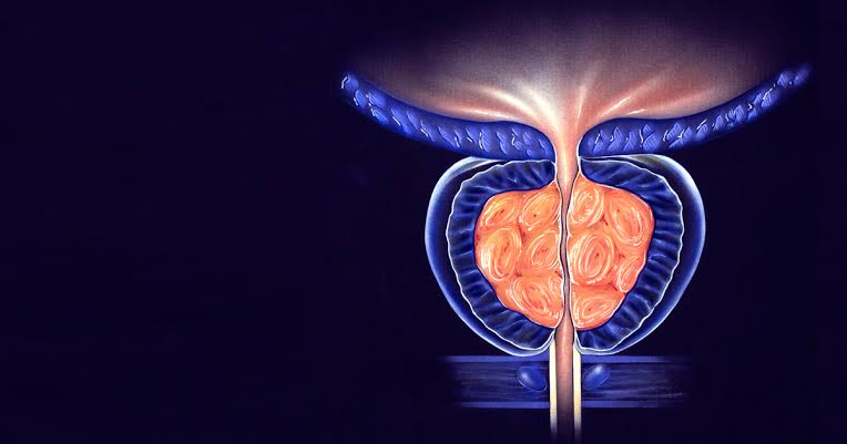 Diferencias entre prostatitis, próstata agrandada (HBP) y cáncer de próstata