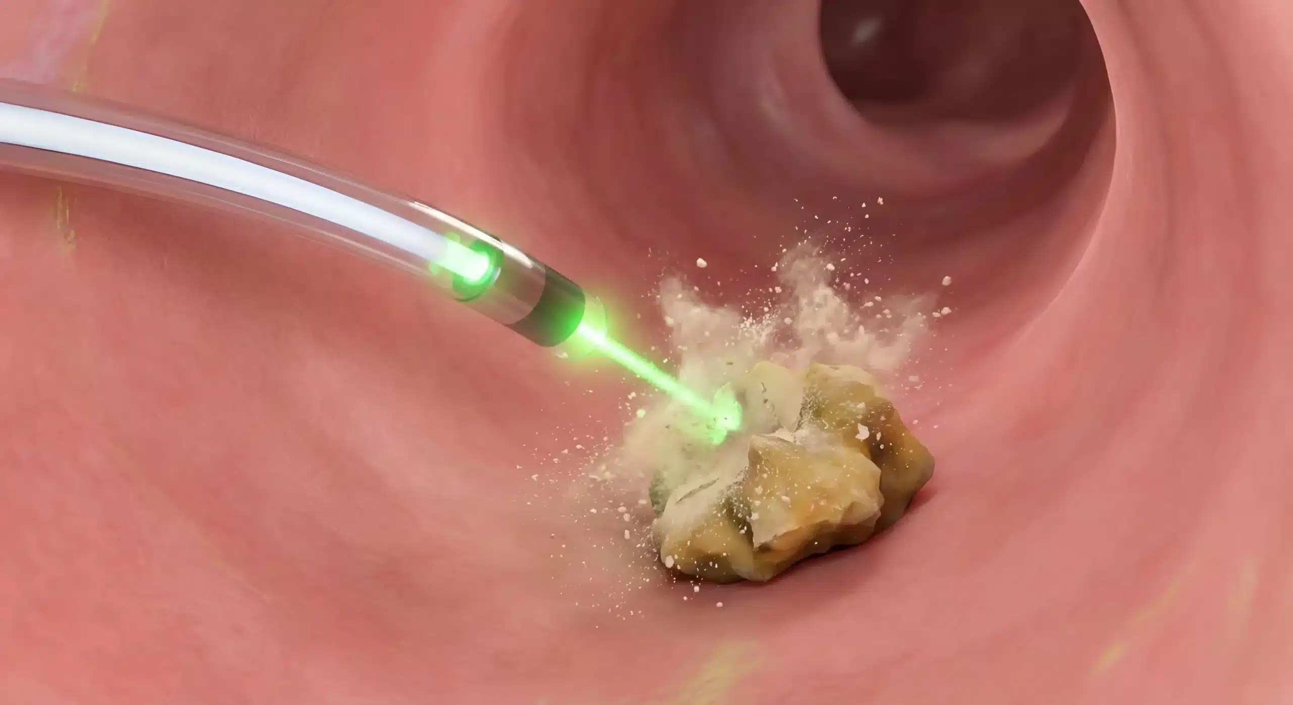 ¿Cómo eliminar cálculos renales sin dolor? 